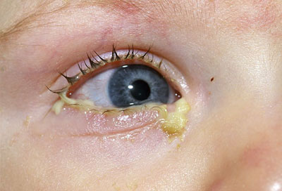выделения из глаз ребенка